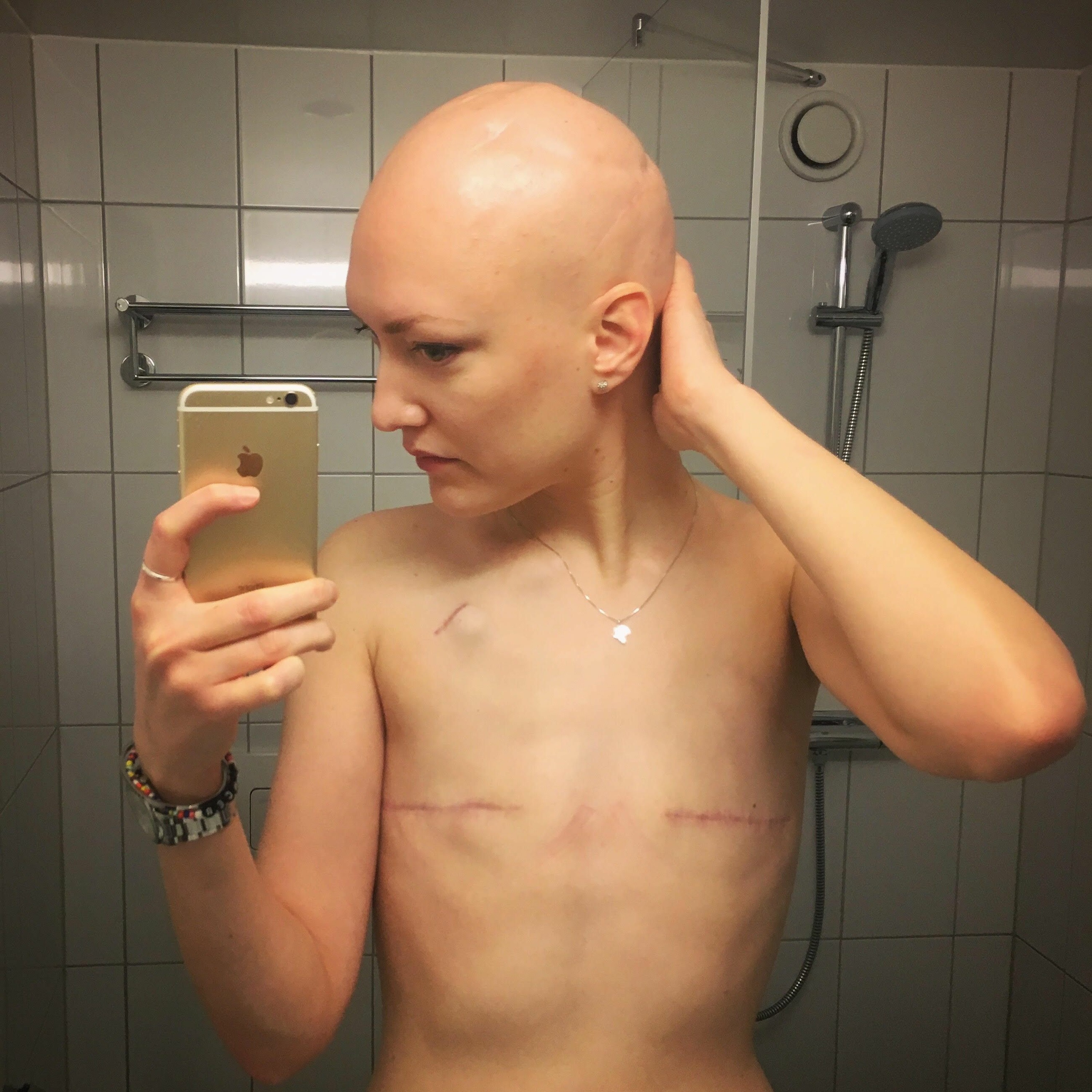 Med cancern som ständig följeslagare - Emma Skoglund