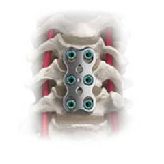 TITANIUM SPINE SHORT CLIP 1.1
