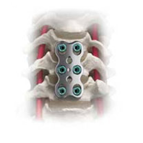 TITANIUM SPINE SHORT CLIP 1.1