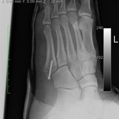 Lee Jones Broken Foot Mix