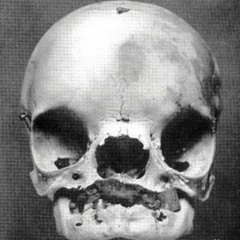 Treacher collins synd