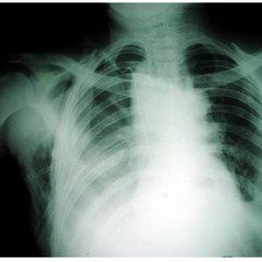 Collapsed Lung