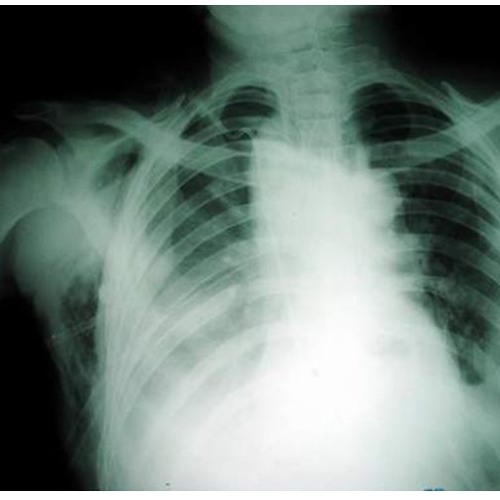 Collapsed Lung
