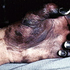 Dissiminated Inravascular Coagulation
