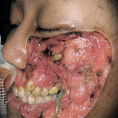 Necrotizing Faciitis