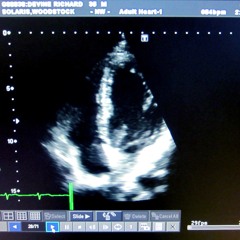 Recordings of my Echocardiogram-Cardiac Ultrasound-Sounds of blood flow