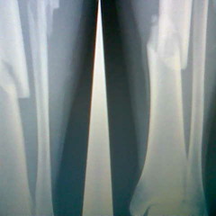 Broken Bones