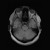 Artwork for brain_tumor_test_2000