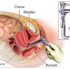 The Spit Speculum