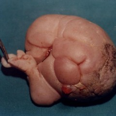 A Fetus in Fetu