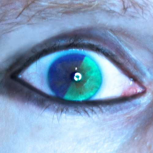 heterochromia
