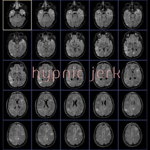 Hypnic Jerk
