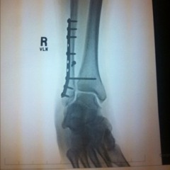 FRACTURE
