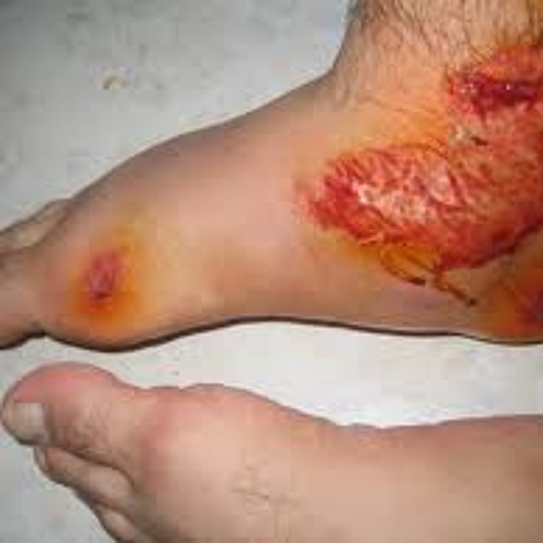 Fujiya & Miyagi - Ankle Injuries (Blax Limp Mix)