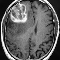 Escuela Enferma - Tumor Cerebral (Rencoroso - Edez - Adonis)
