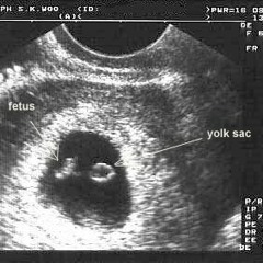 trapped feelings - miscarriage 2010