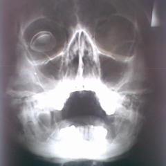 Botched Brain Surgery