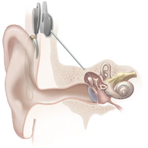 Prof. Atlas, University of Washington, New strategy lets cochlear implant users hear music