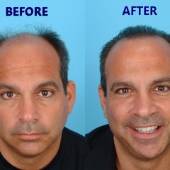 Greek's Hair Transplant Interview