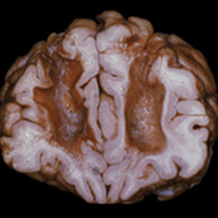 Psychedelic Leftovers For Sunday Brunch (Chapter 'Prefrontal Lobotomy')