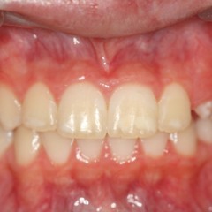 Bone & Moral Fibre - Crossbite [CLIP]