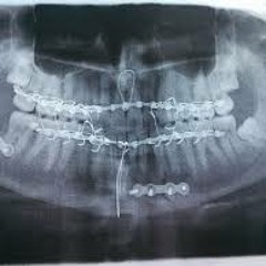 Wired Shut - Bruc3 - Mesa Made Records