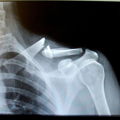 broken_bones (day 2)