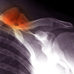 broken collarbone blues 2014