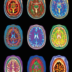 Anomic Aphasia