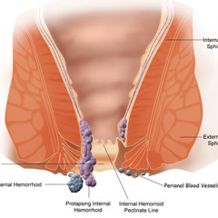 Hemorrhoid