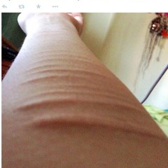 Unge udstiller blodige snitsår på sociale medier