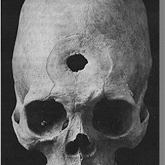 Psychosurgery