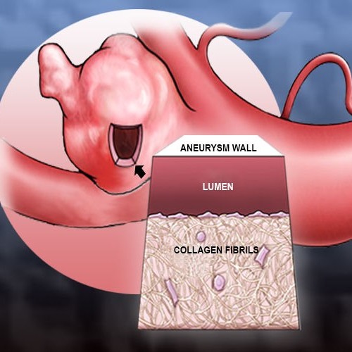 a description of brain aneurysm a bulge formed by the ballooning of the wall of an artery or a vein (brain aneurysm) varicose aneurysm one formed by rupture of an aneurysm into a vein saccular aneurysm sac-like ballooning of an artery wall aneurysm. a description of brain aneurysm a bulge formed by the ballooning of the wall of an artery or a vein (brain aneurysm) varicose aneurysm one formed by rupture of an aneurysm into a vein saccular aneurysm sac-like ballooning of an artery wall aneurysm.