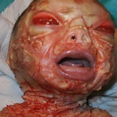 Intestinal Noose - Kelly's Abortion Clinic (You Rape 'Em, We Scrape 'Em)