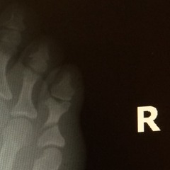 What Happened To My Foot