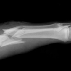 The Happy Hour - Prank Call #2 Jimmy needs a chiropractor