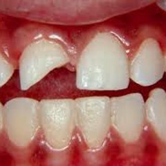 Cracks In Teeth