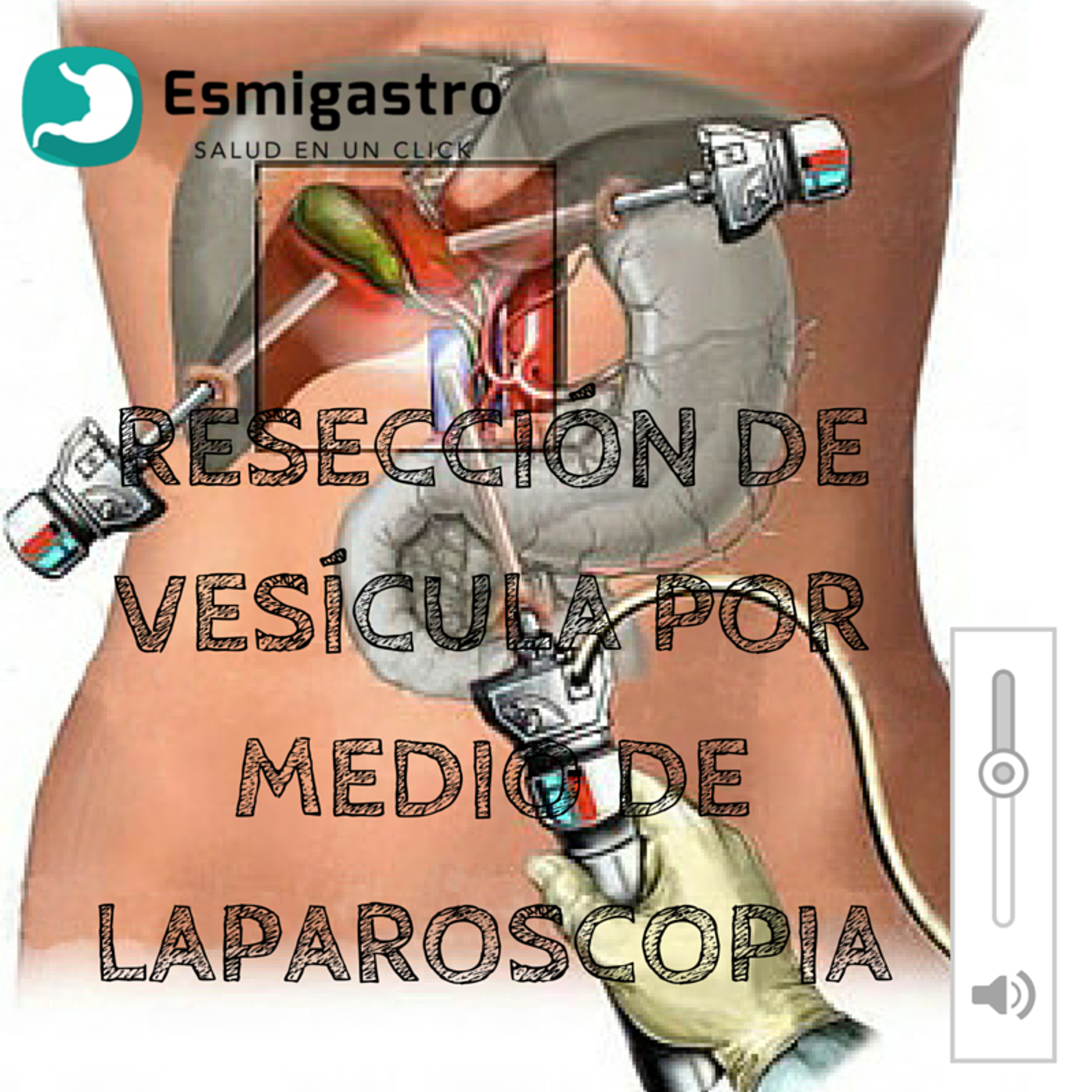 Resección de vesícula por medio de laparoscopia episode artwork