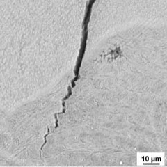 Mikrorisse an der Achillessehne
