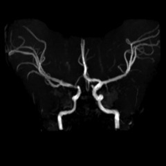Boggan - Distal End