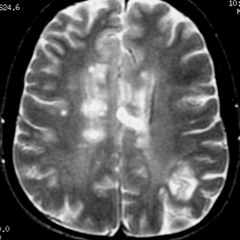 Brain Scars