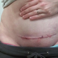 C SECTION SKIPLESS CUTS