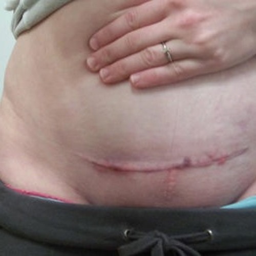 C SECTION SKIPLESS CUTS