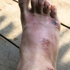 Fracture