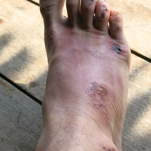 Fracture
