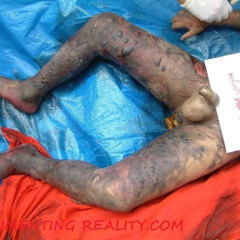 AGONIZING SEPSIS- blue bloaters