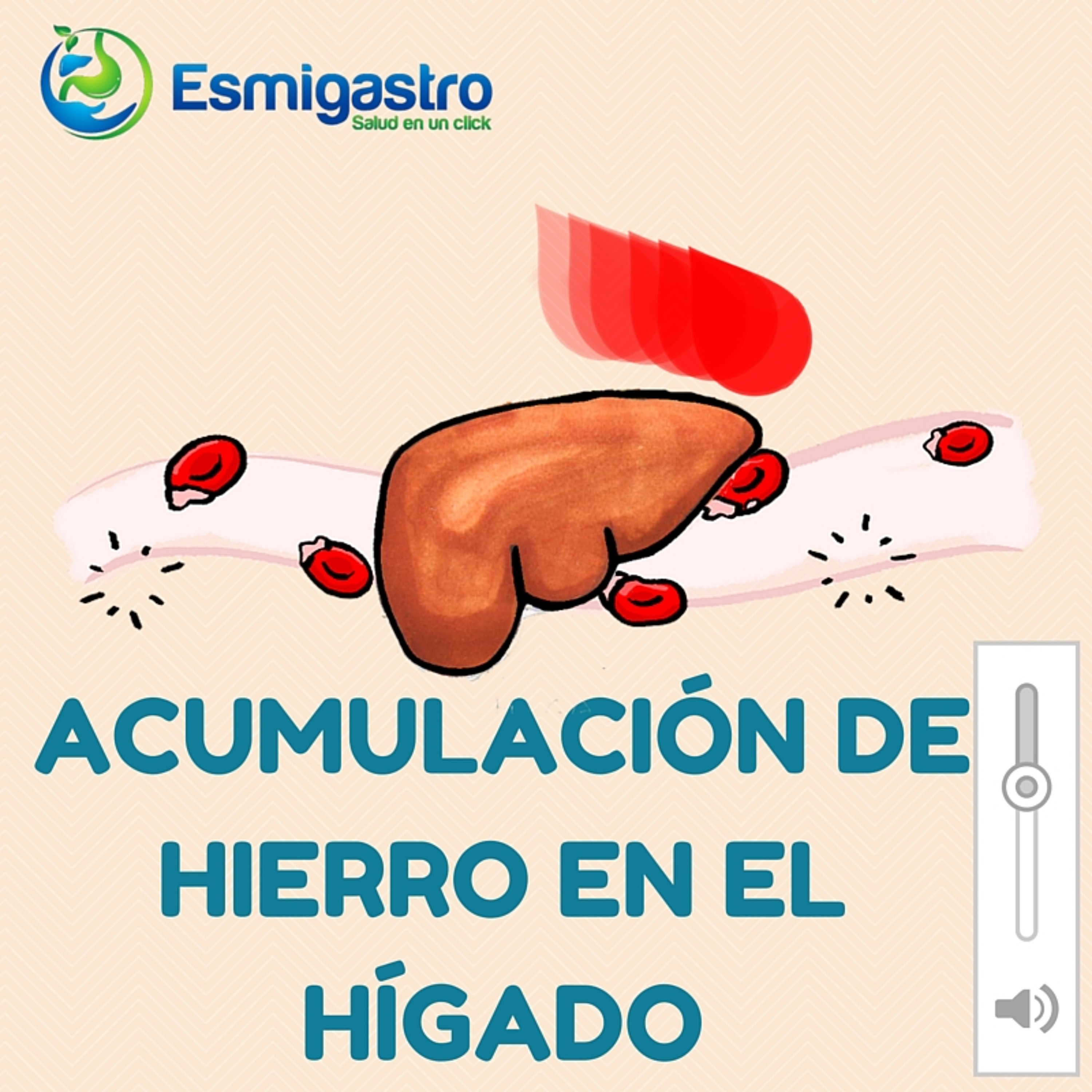 Acumulación de Hierro y Síndrome Metabólico episode artwork