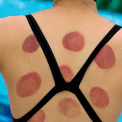 10 - Cupping, green pools and PEDs