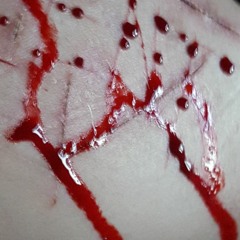 Suicide