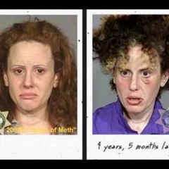 Permanent Brain Damage Due to Amphetamines